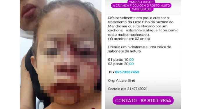 Criança fica com rosto desfigurado após ataque de cachorro no Piauí